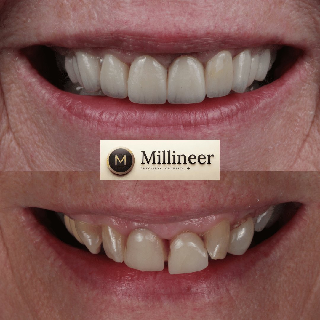 Veneer before and after, Millineer