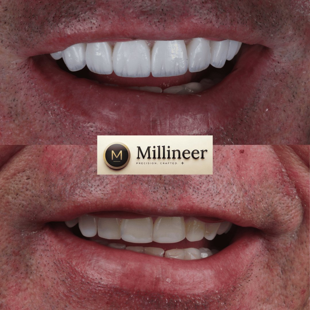 Veneer before and after, Millineer