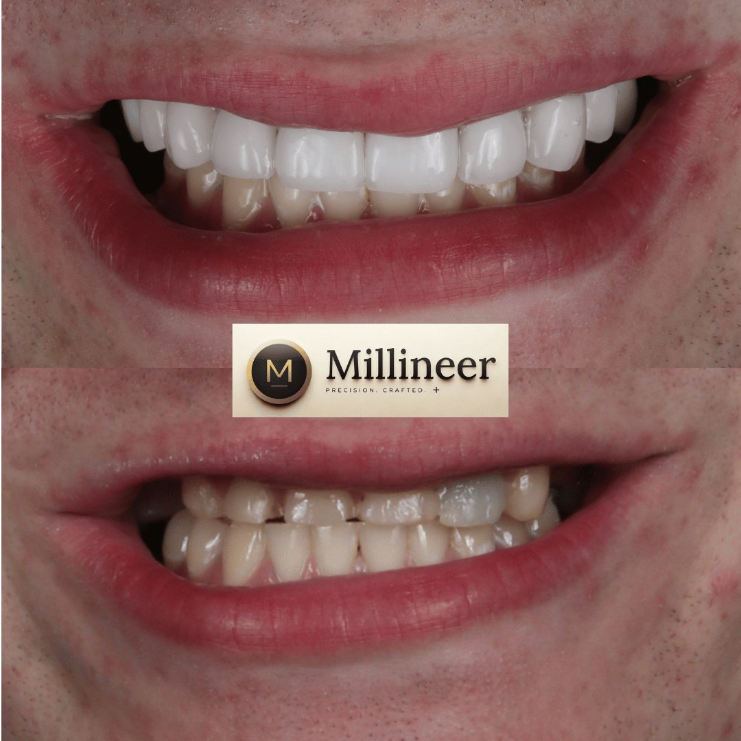 Veneer before and after, Millineer