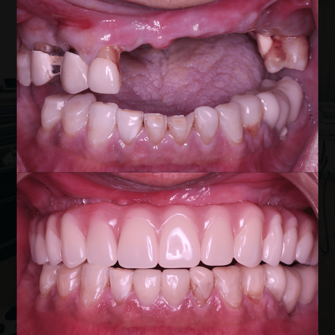 Implant before and after, case 2