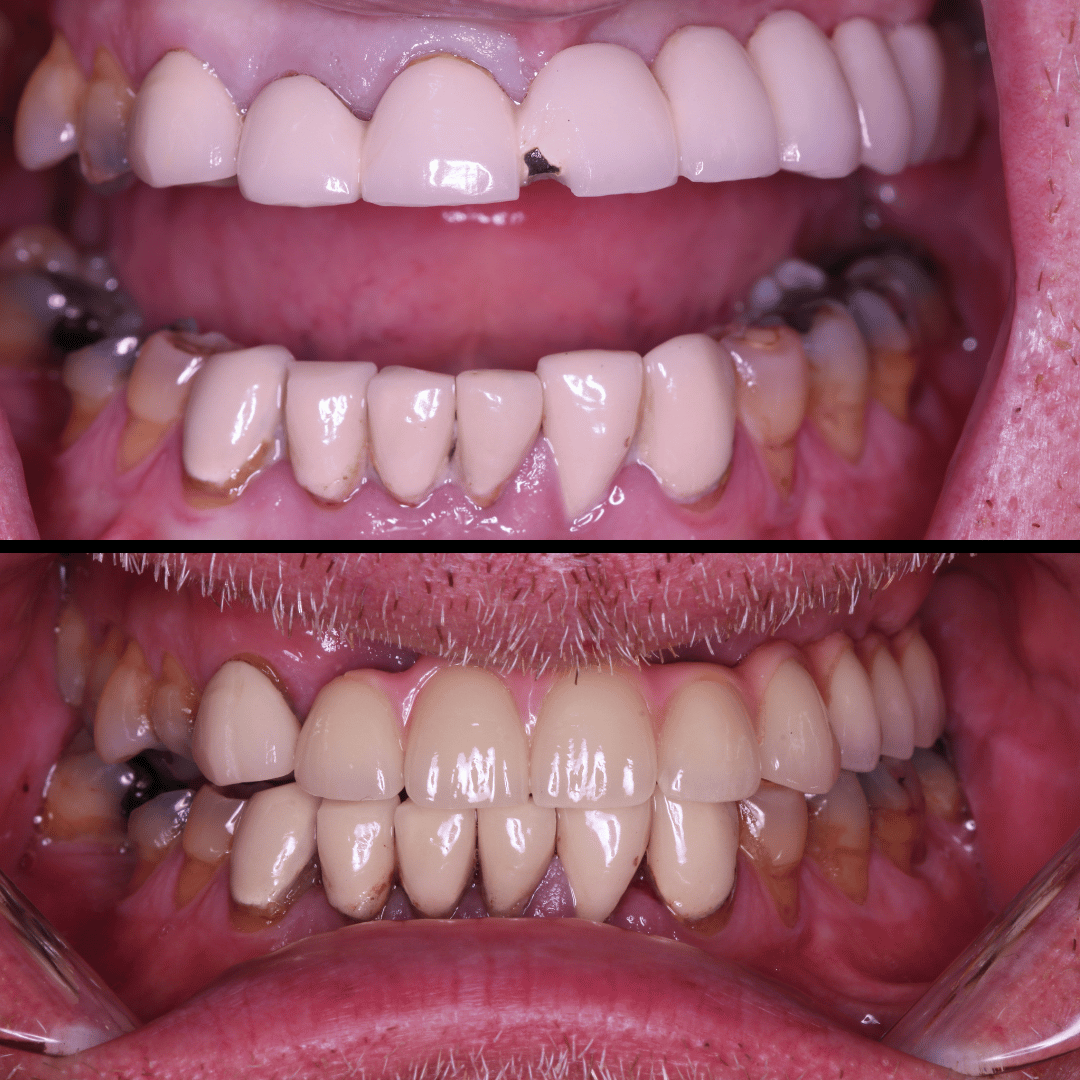 Implant before and after, case 3
