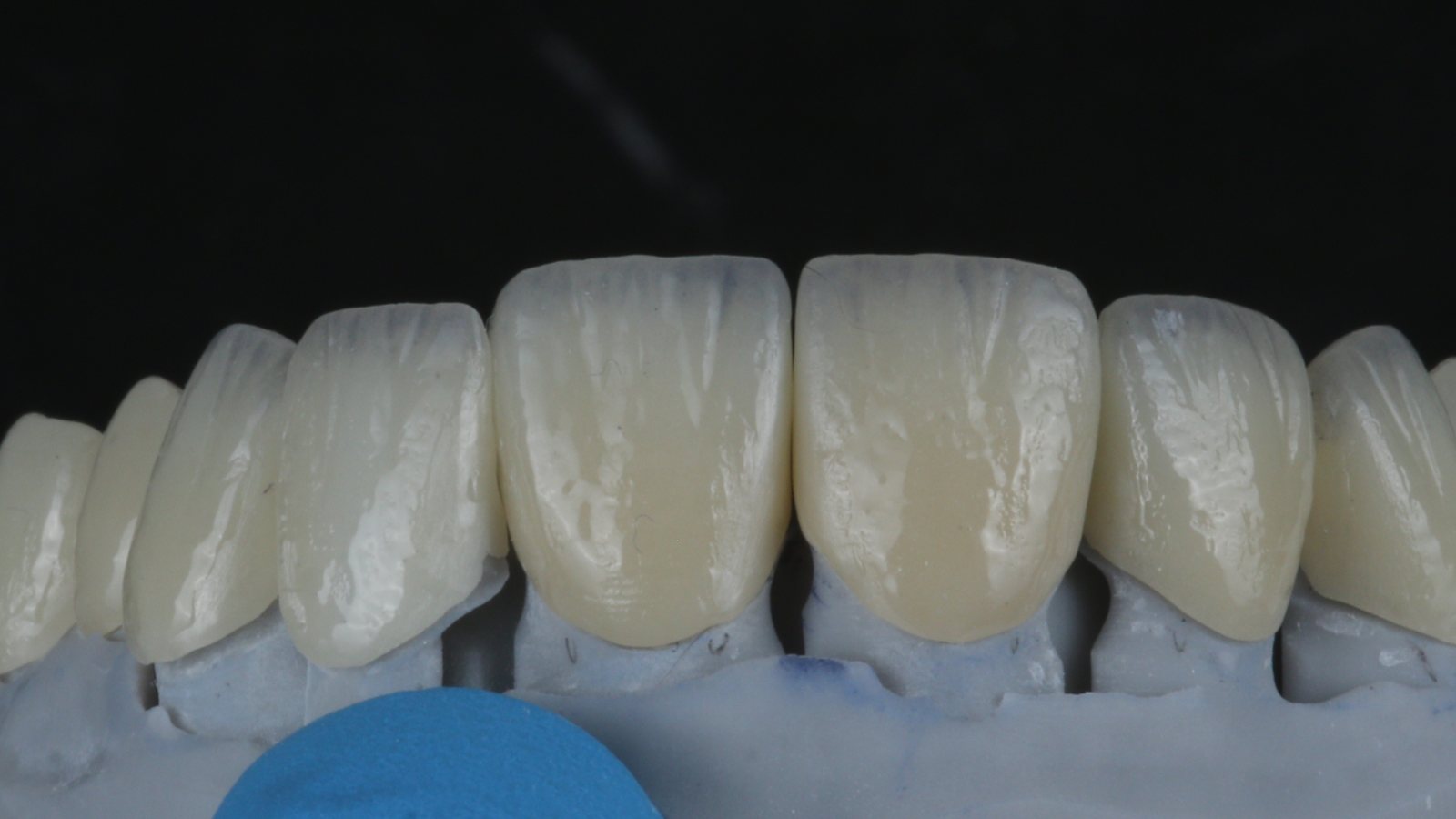 Millineer ceramic veneers in a natural shade, on the lab model