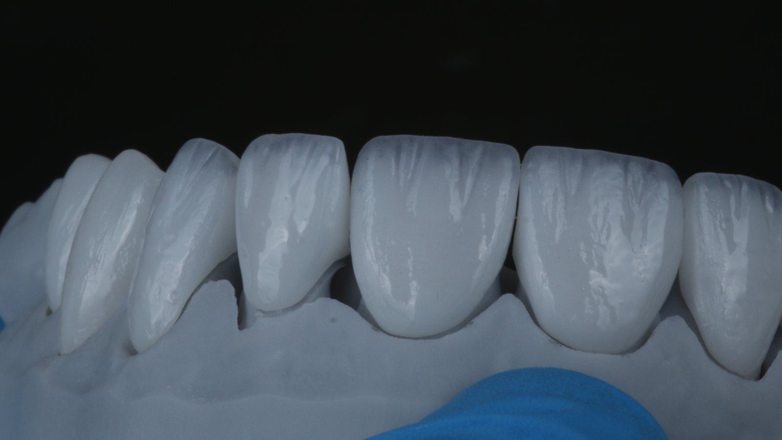 Millineer ceramic veneers in a bright white shade, on the lab model